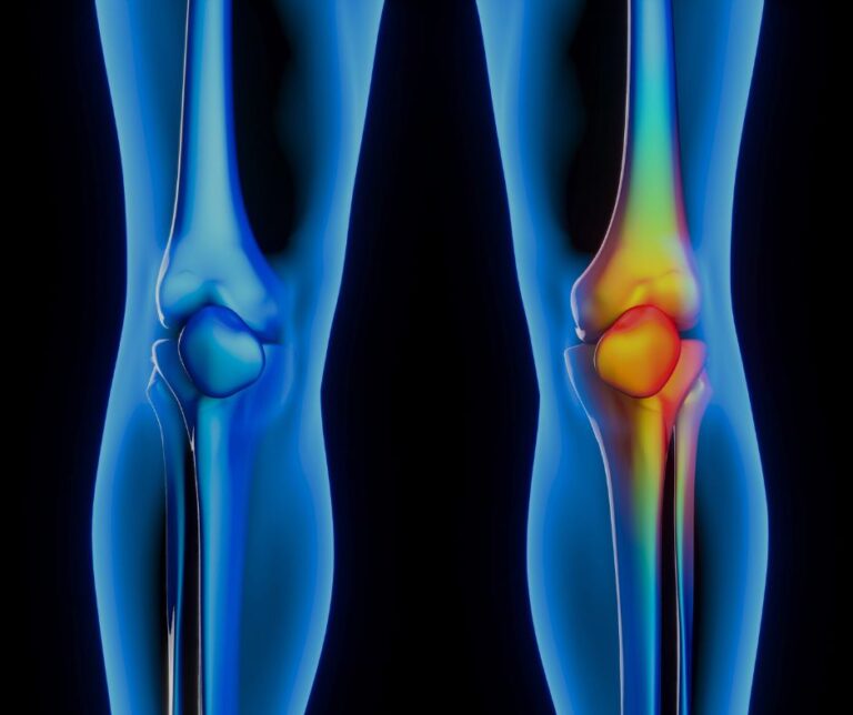 Authentic Arthritis Asian Herbs - What is Arthritis