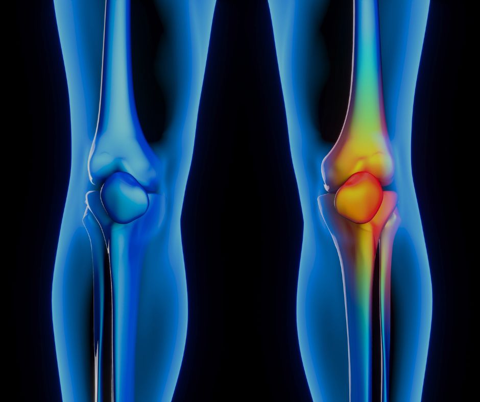 Authentic Arthritis Asian Herbs - What is Arthritis